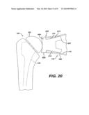 Concave Resurfacing Prosthesis diagram and image