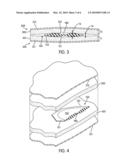 Sports Glove With Impact Force Attenuation System diagram and image