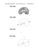 DEVICE FOR GENERATING ALTERNATIVE OF NORMAL BRAIN DATABASE diagram and image