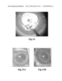 DEVICE AND METHOD FOR INTRAOCULAR DRUG DELIVERY diagram and image