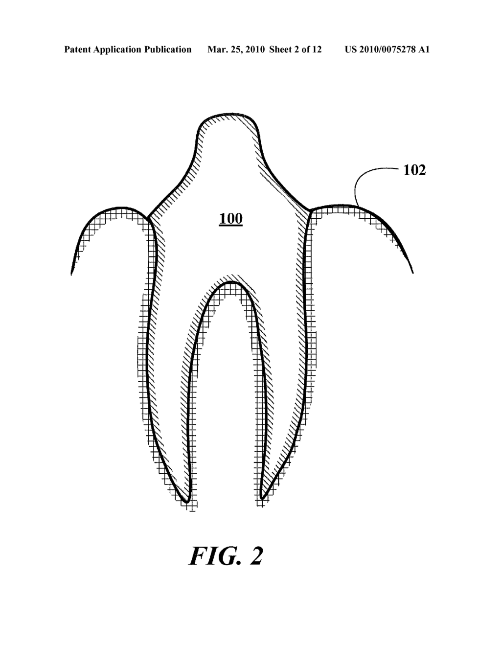 Dental Prosthetics Having Improved Aesthetic Appearance and Method of Preparing Same - diagram, schematic, and image 03