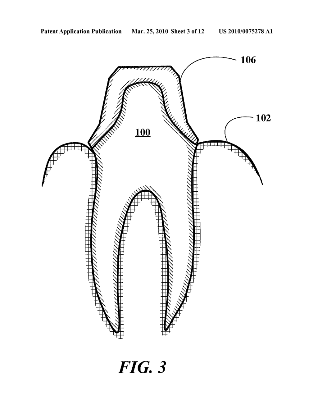 Dental Prosthetics Having Improved Aesthetic Appearance and Method of Preparing Same - diagram, schematic, and image 04