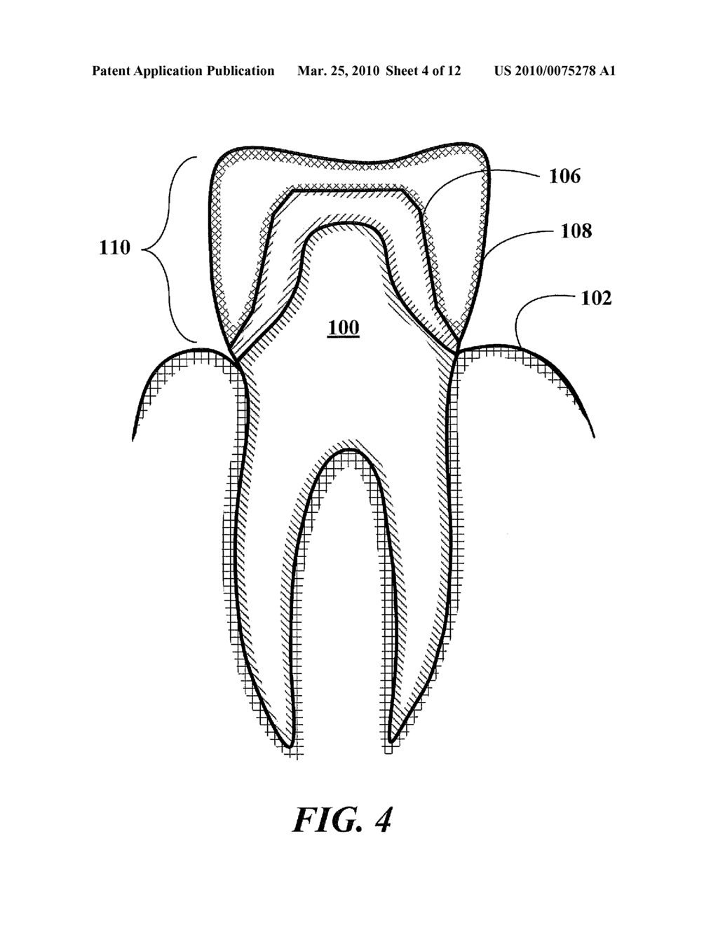 Dental Prosthetics Having Improved Aesthetic Appearance and Method of Preparing Same - diagram, schematic, and image 05