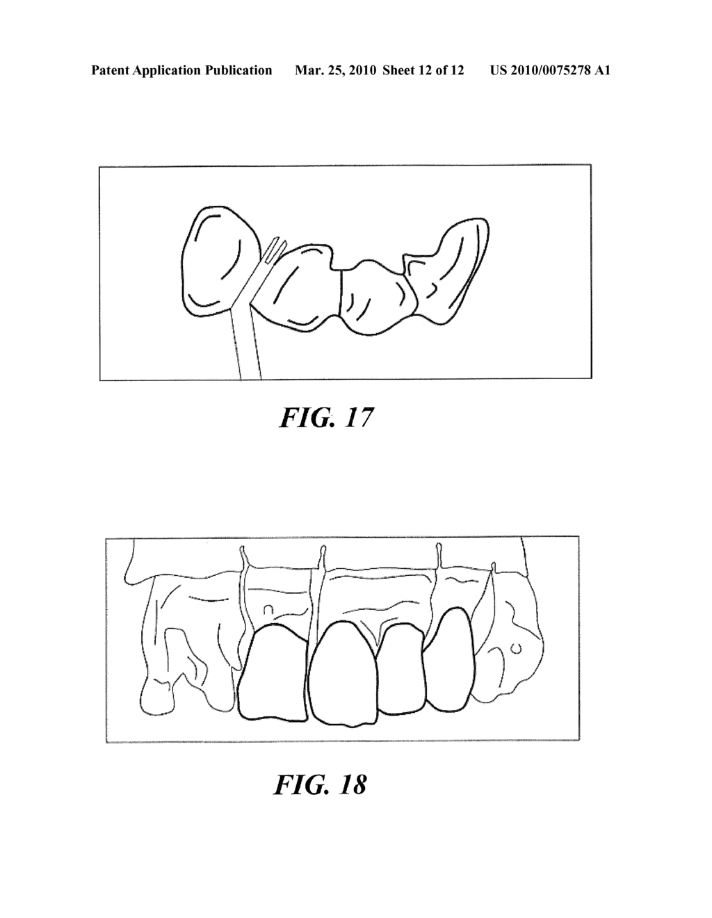 Dental Prosthetics Having Improved Aesthetic Appearance and Method of Preparing Same - diagram, schematic, and image 13