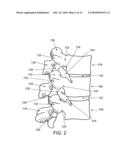 SYSTEMS AND METHODS FOR CABLE-BASED TISSUE REMOVAL diagram and image