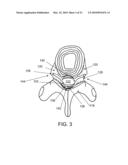 SYSTEMS AND METHODS FOR CABLE-BASED TISSUE REMOVAL diagram and image