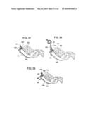 Curvilinear spinal access method and device diagram and image