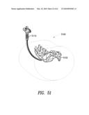 Curvilinear spinal access method and device diagram and image