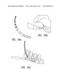 Curvilinear spinal access method and device diagram and image