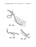 Curvilinear spinal access method and device diagram and image