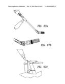 Curvilinear spinal access method and device diagram and image