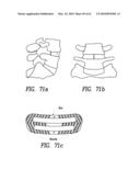 Curvilinear spinal access method and device diagram and image