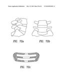 Curvilinear spinal access method and device diagram and image