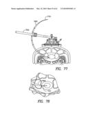 Curvilinear spinal access method and device diagram and image