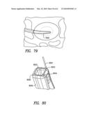 Curvilinear spinal access method and device diagram and image