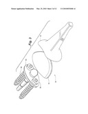 PROSTHETIC WRIST IMPLANT diagram and image