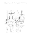 PROSTHETIC WRIST IMPLANT diagram and image