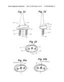 PROSTHETIC WRIST IMPLANT diagram and image