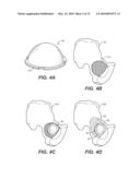 DEVICE AND METHOD FOR RECONSTRUCTION OF OSSEOUS SKELETAL DEFECTS diagram and image