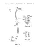 Linearly Expandable Ureteral Stent diagram and image