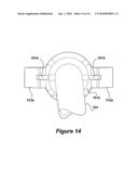 Medical Device Tube having a Flange with Opposing Support Ears for Improved Alignment and Retention of an Inner Cannula in an Outer Cannula diagram and image