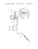 SINUS LIFT IMPLANT diagram and image