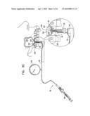 SINUS LIFT IMPLANT diagram and image