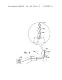 SINUS LIFT IMPLANT diagram and image