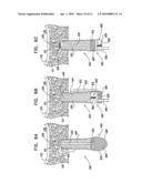 SINUS LIFT IMPLANT diagram and image