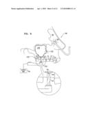 SINUS LIFT IMPLANT diagram and image