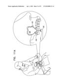 IMPLANTS, TOOLS, AND METHODS FOR SINUS LIFT AND LATERAL RIDGE AUGMENTATION diagram and image