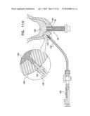 IMPLANTS, TOOLS, AND METHODS FOR SINUS LIFT AND LATERAL RIDGE AUGMENTATION diagram and image