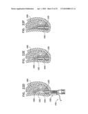 IMPLANTS, TOOLS, AND METHODS FOR SINUS LIFT AND LATERAL RIDGE AUGMENTATION diagram and image