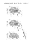 IMPLANTS, TOOLS, AND METHODS FOR SINUS LIFT AND LATERAL RIDGE AUGMENTATION diagram and image