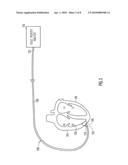 METHOD AND APPARATUS FOR LOCALIZING MYOCARDIAL INFARCTION DURING CATHETERIZATION diagram and image