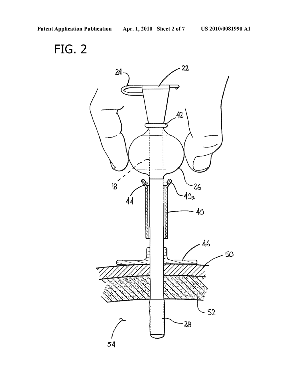 MEDICAL DEVICE HAVING PREFILLED BALLON - diagram, schematic, and image 03