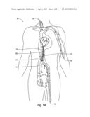 GUIDEWIRE REPLACEMENT DEVICE diagram and image