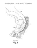 APPARATUS AND METHOD FOR DRIVING A HEMORRHAGE OCCLUDER PIN INTO A HUMAN SACRUM diagram and image