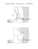 APPARATUS AND METHOD FOR DRIVING A HEMORRHAGE OCCLUDER PIN INTO A HUMAN SACRUM diagram and image