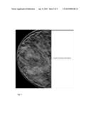 Breast Tomosynthesis With Display Of Highlighted Suspected Calcifications diagram and image