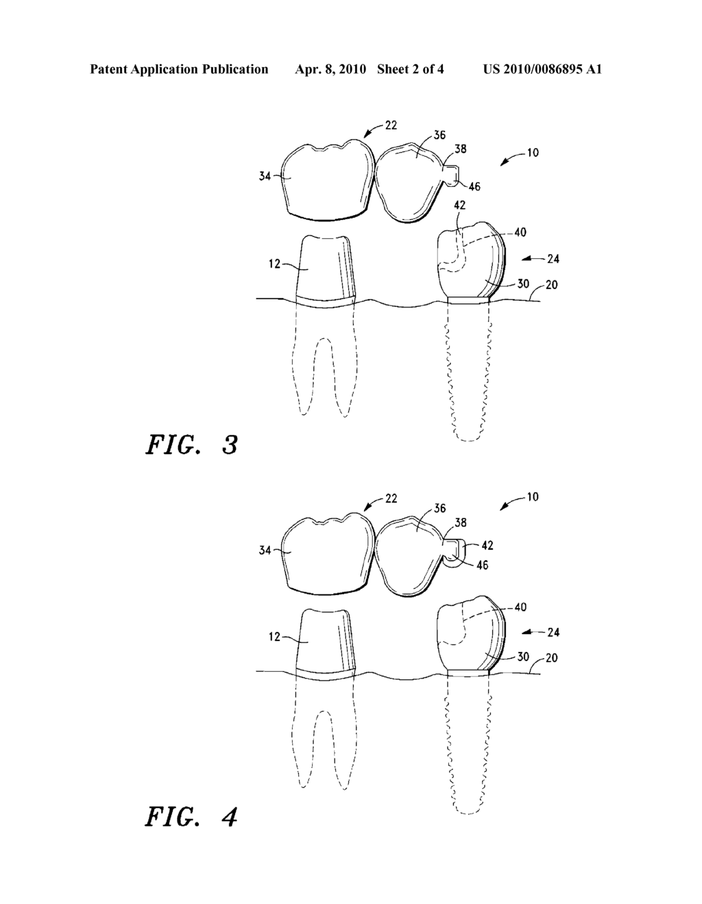 Dental Bridge - diagram, schematic, and image 03