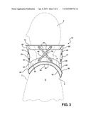 NECK CAST WITH MULTI-POSITION ADJUSTABILITY OF HEIGHT AND DIAMETER AND INCLUDING DOWNWARDLY CONFIGURED SHOULDER SUPPORTS FOR IMMOBILIZING A PATIENT S HEAD diagram and image