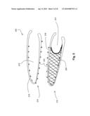 SYSTEMS AND METHODS FOR VALVE ANNULUS REMODELING diagram and image