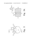 Repair System for Spinal Disc Herniation diagram and image