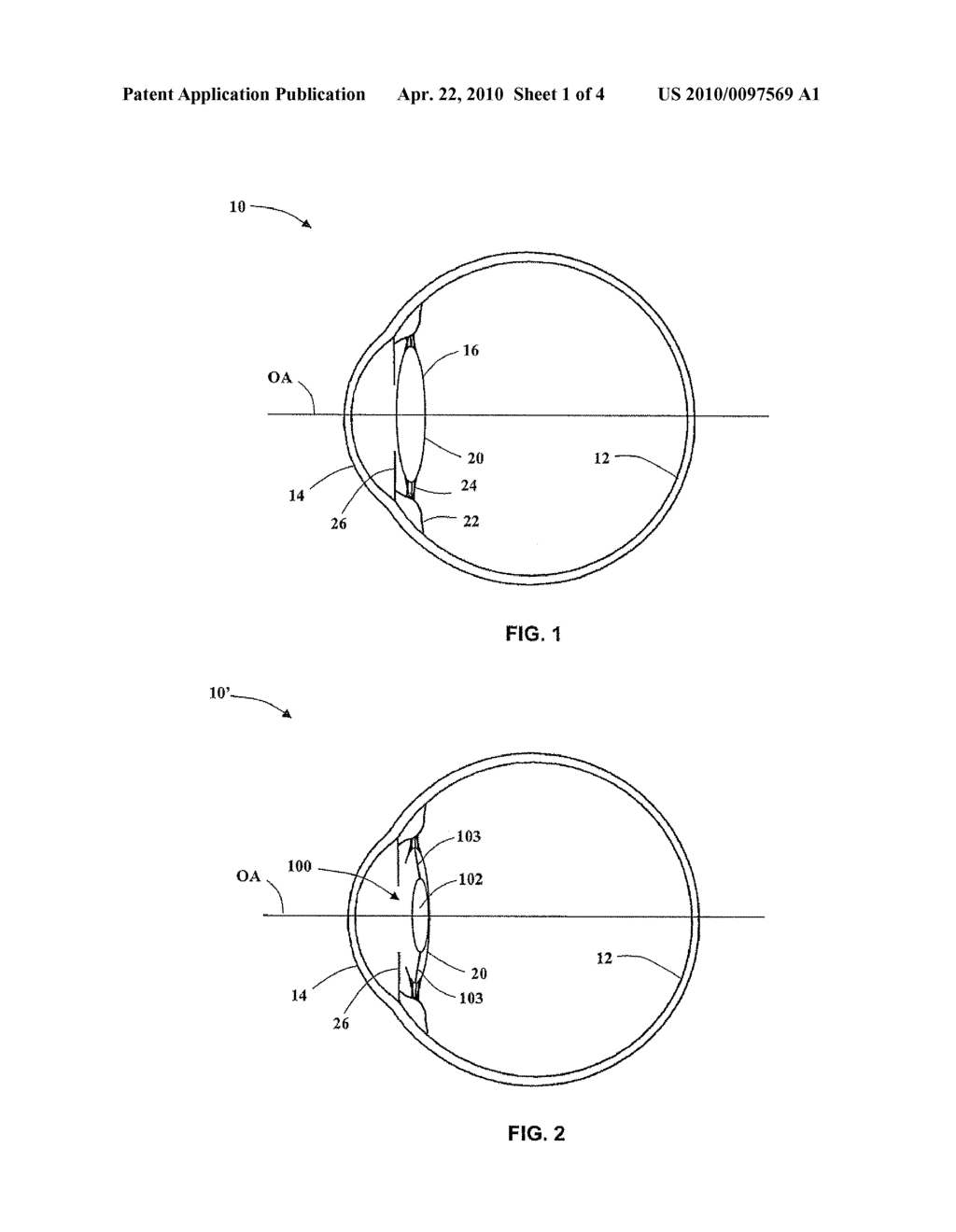 Multifocal Intraocular Lens - diagram, schematic, and image 02