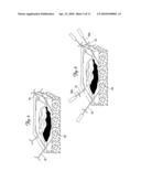 METHOD AND SYSTEM FOR THE USE OF HOLLOW FIBER CATHETERS IN TOPICAL APPLICATIONS diagram and image