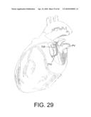 TISSUE ABLATION SYSTEMS diagram and image