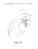 TISSUE ABLATION METHODS diagram and image