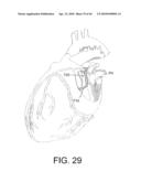 TISSUE ABLATION METHODS diagram and image