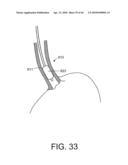 TISSUE ABLATION METHODS diagram and image